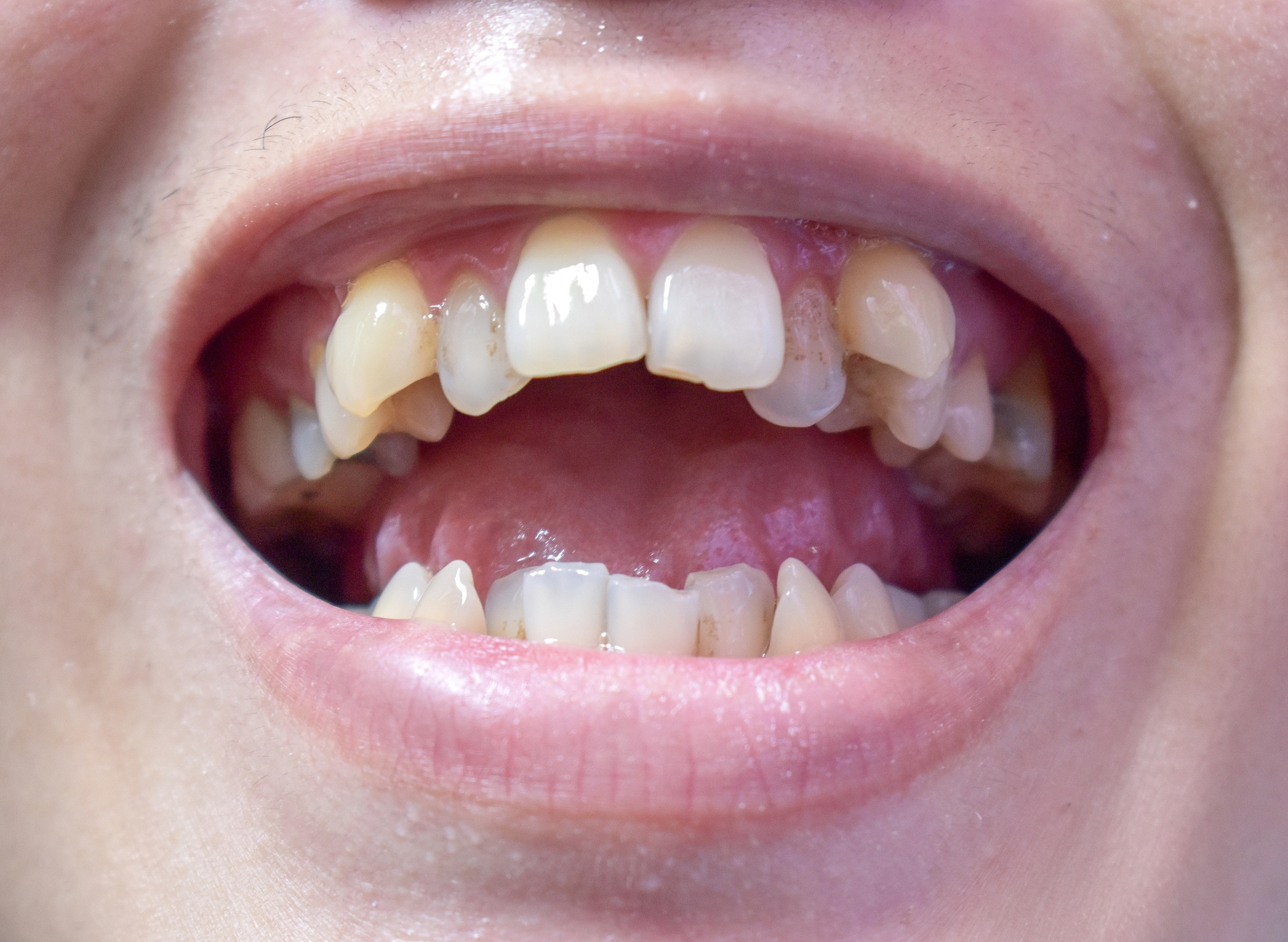 Crooked Front Teeth | How Do Teeth Move?