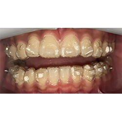 aligners on teeth from front