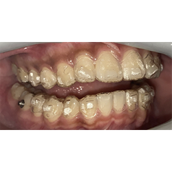 aligners on teeth right side