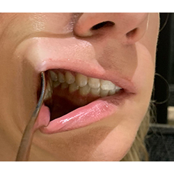teeth biting right side