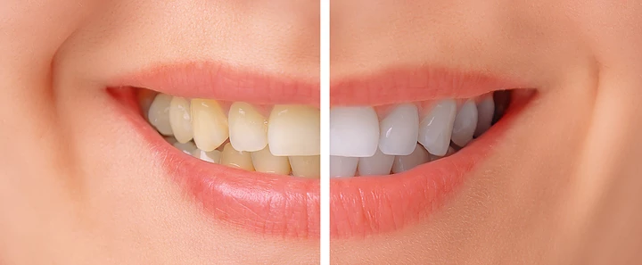 Can Yellow Teeth Be Whitened?