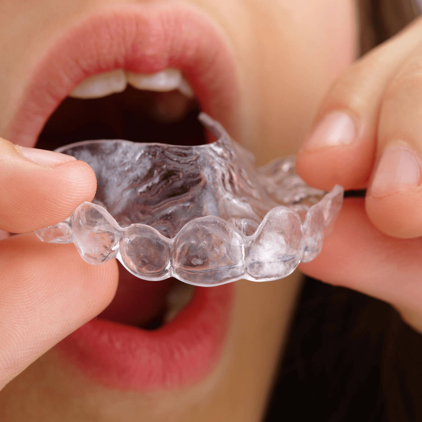 Should My Child Get Braces or Invisalign?