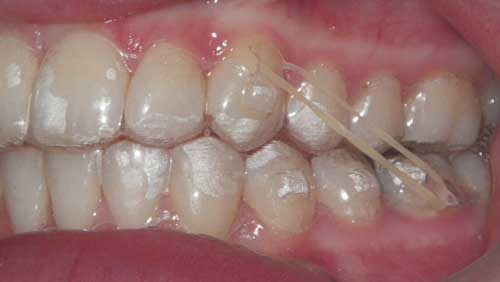 Invisalign treatment with elastic for bite correction