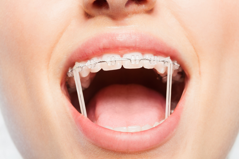 braces with metal wires and elastics