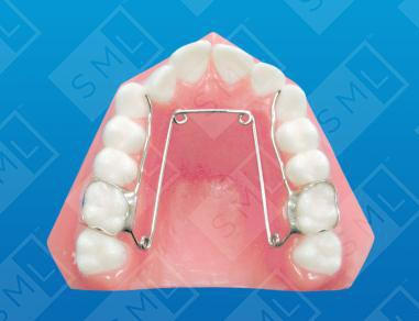 Quad helix to expand the palate, dental treatment