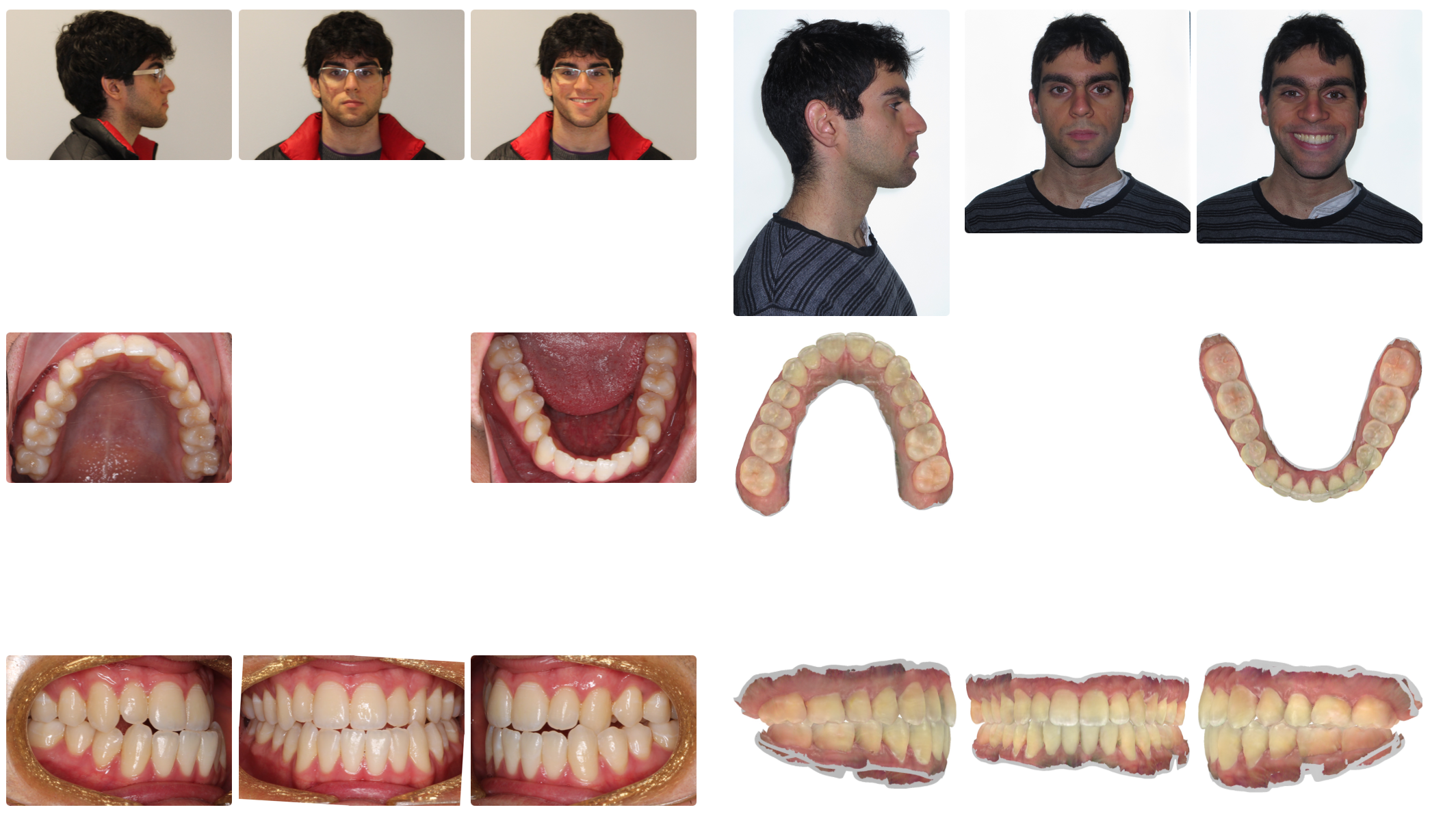 corrective jaw surgery to fix an underbite