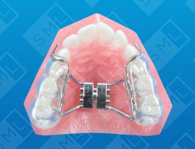 kids can need an expander to fix their smile