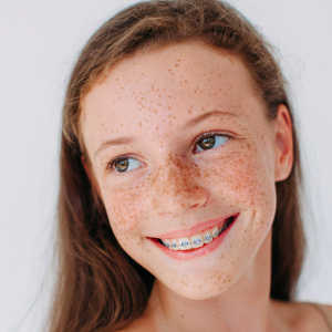 teen girl smiles with ceramic braces on teeth