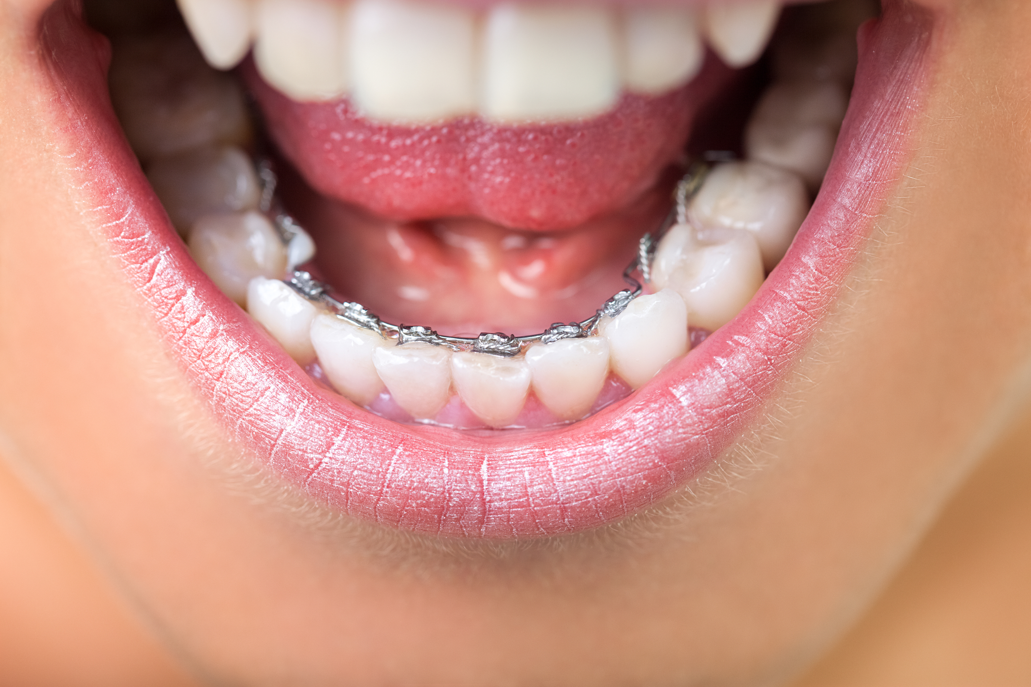 lingual braces are hidden and best for adults