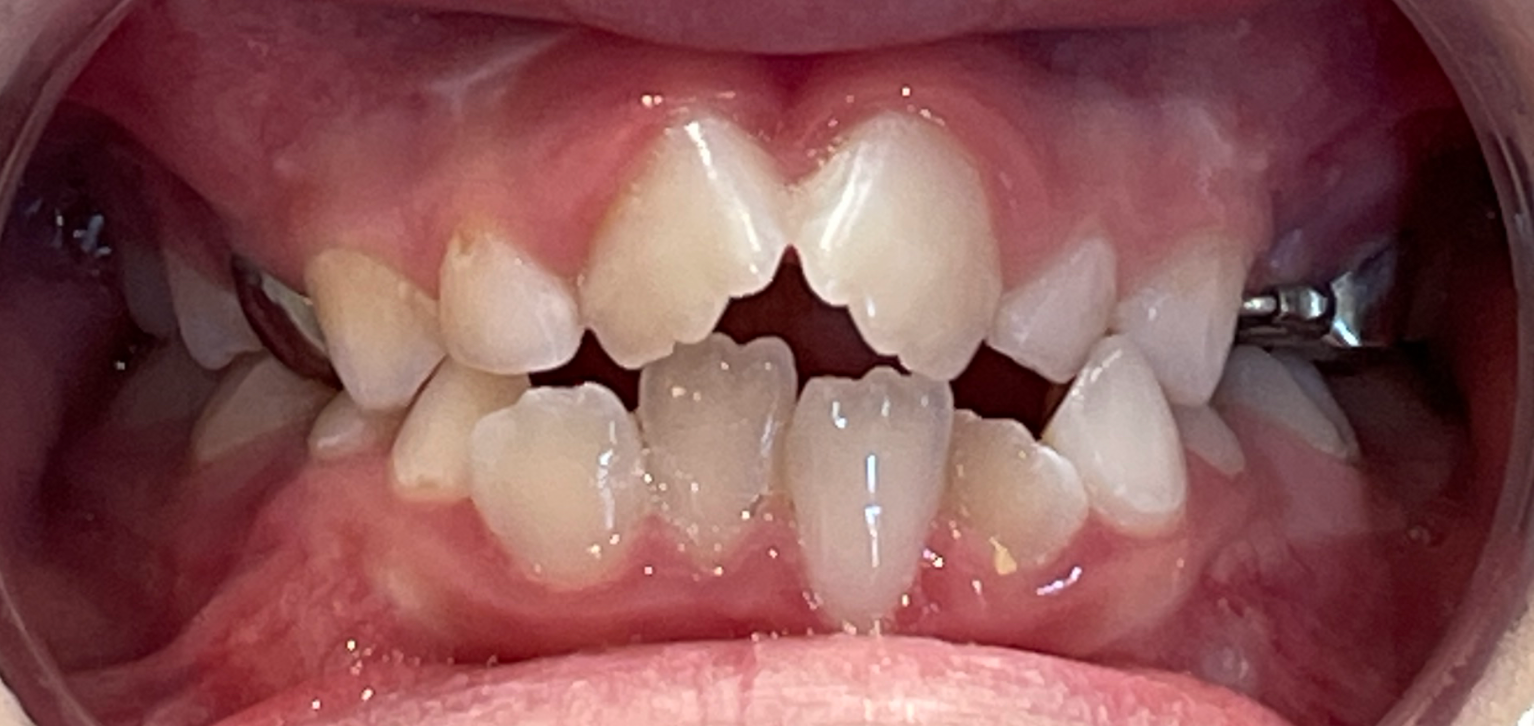 A photo of misaligned teeth with some baby teeth and some permanent teeth