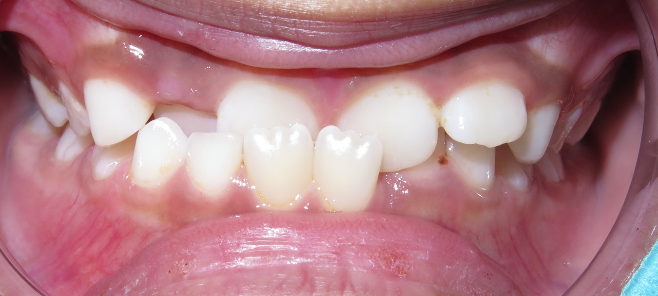 photo of underbite that when treated can prevent even jaw surgery