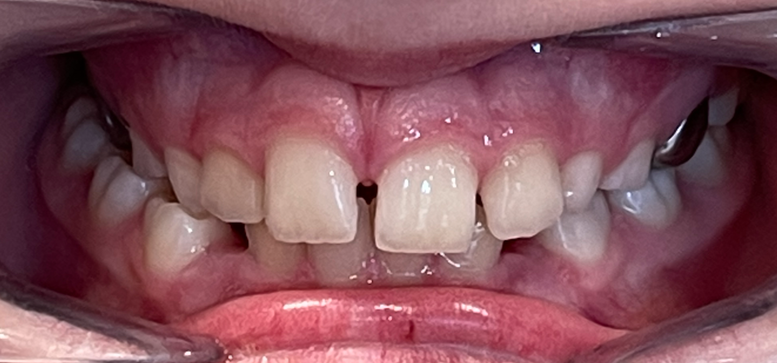 photo of a posterior crossbite that is treated in phase 1 orthodontic treatment