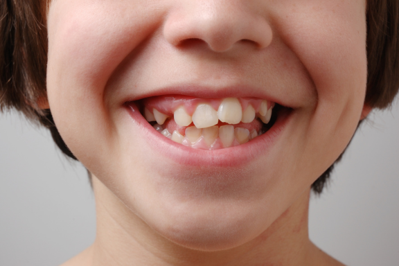 young boy with crooked teeth