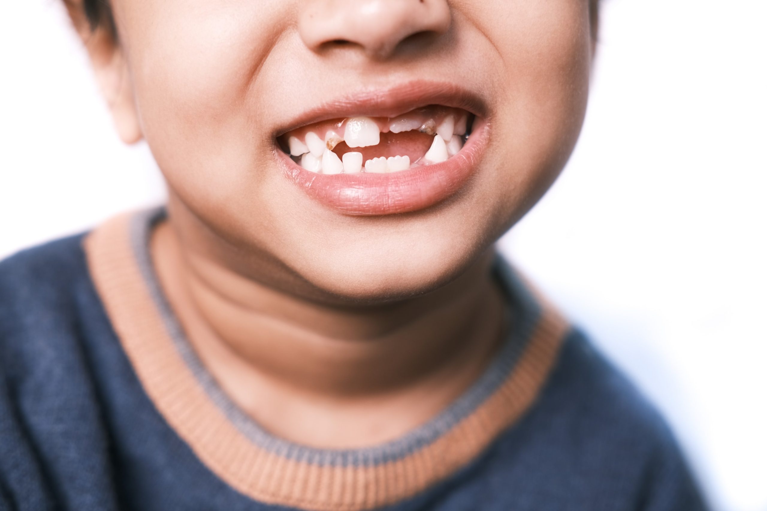 Kid with crooked bottom teeth