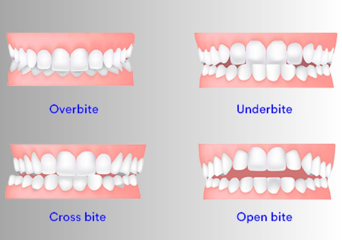 Image showing types of bites