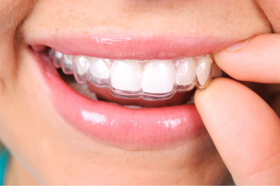 close up of a mouth showing clear plastic orthodontic appliance worn to maintain teeth after wearing braces