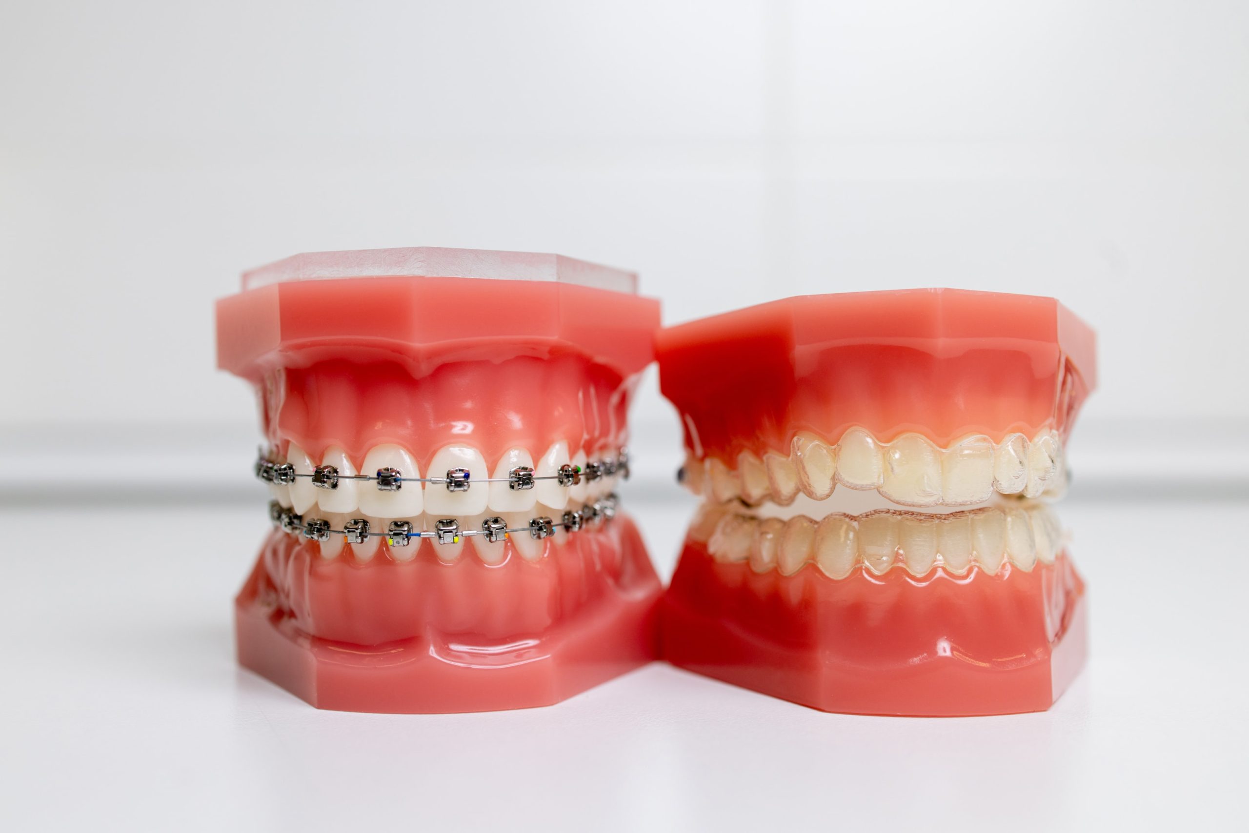 Dental models showing treatment options with Invisalign and Braces