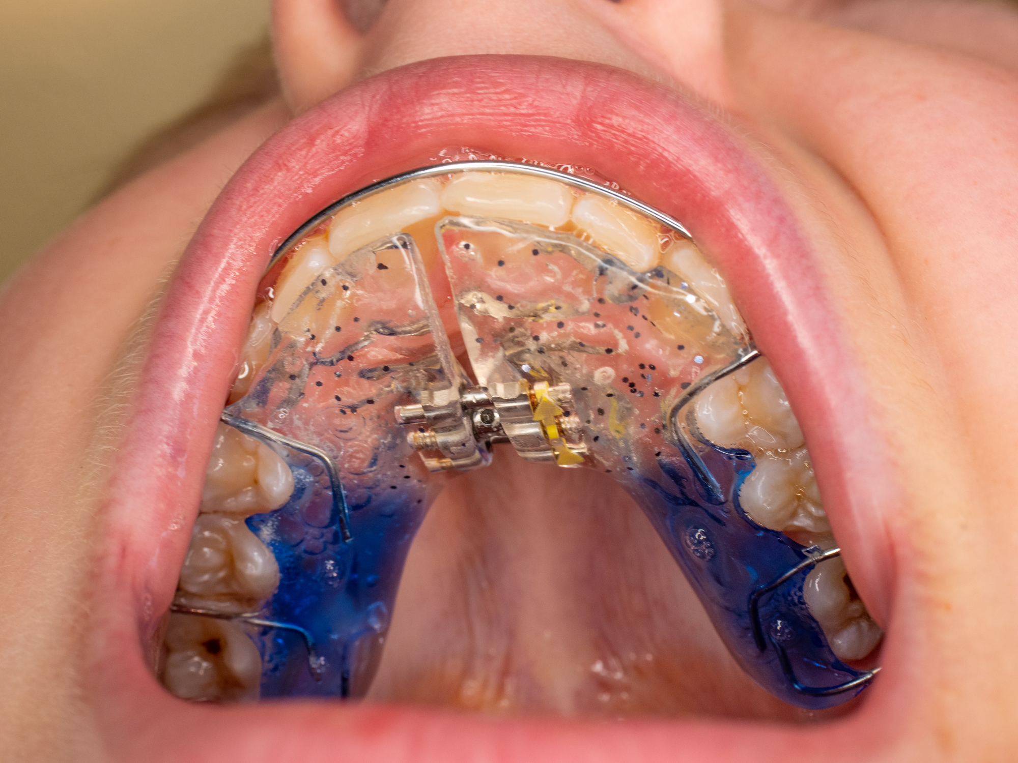 a removable palatal expander on the upper jaw used for skeletal expansion