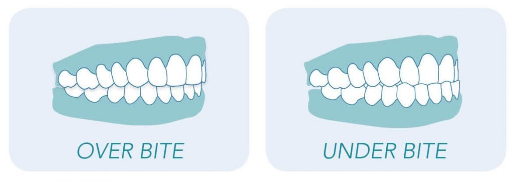 Image representing the difference between and underbite and an overbite