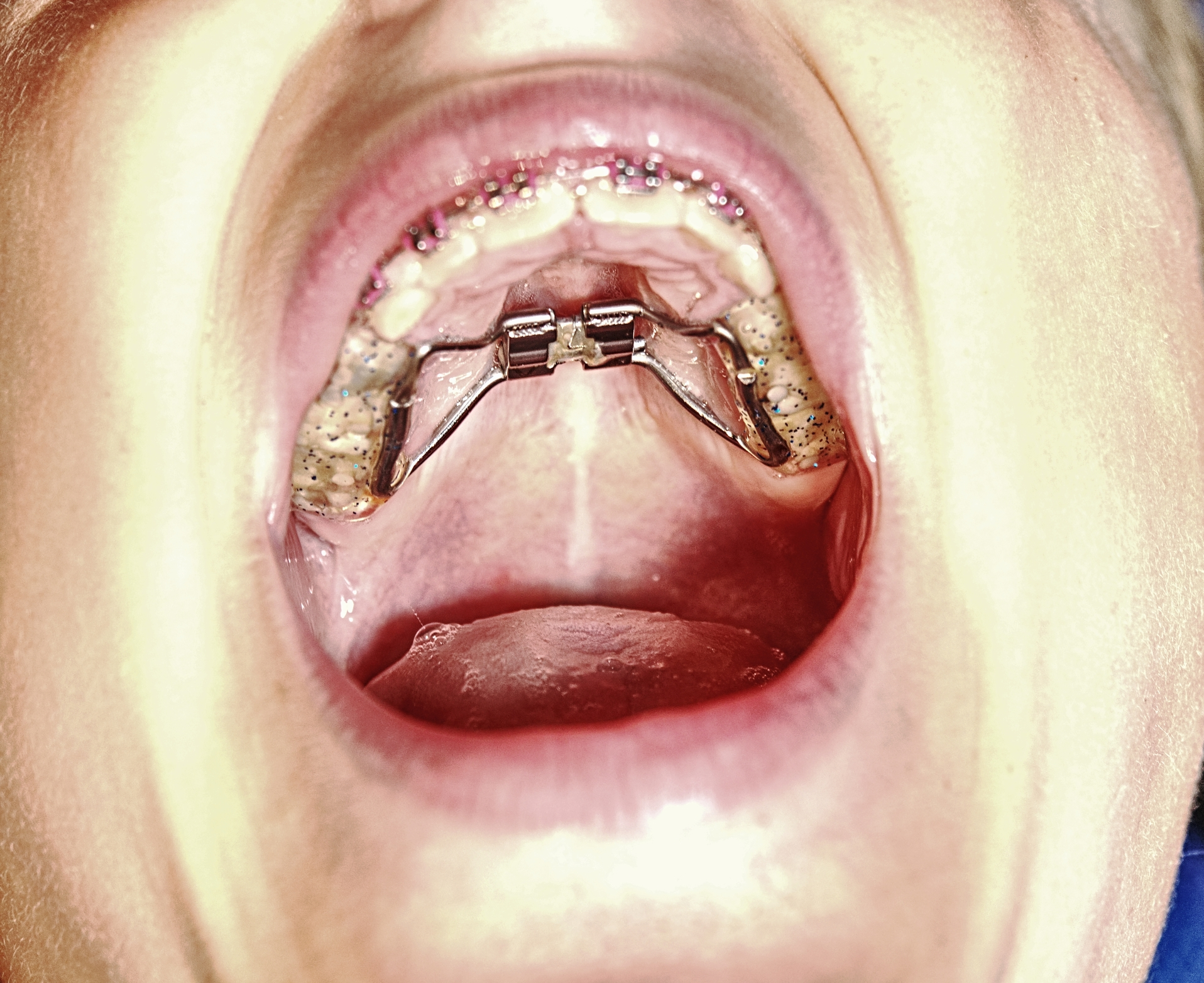 A photo of a mouth with a palatal expander glued to the upper jaw via the teeth