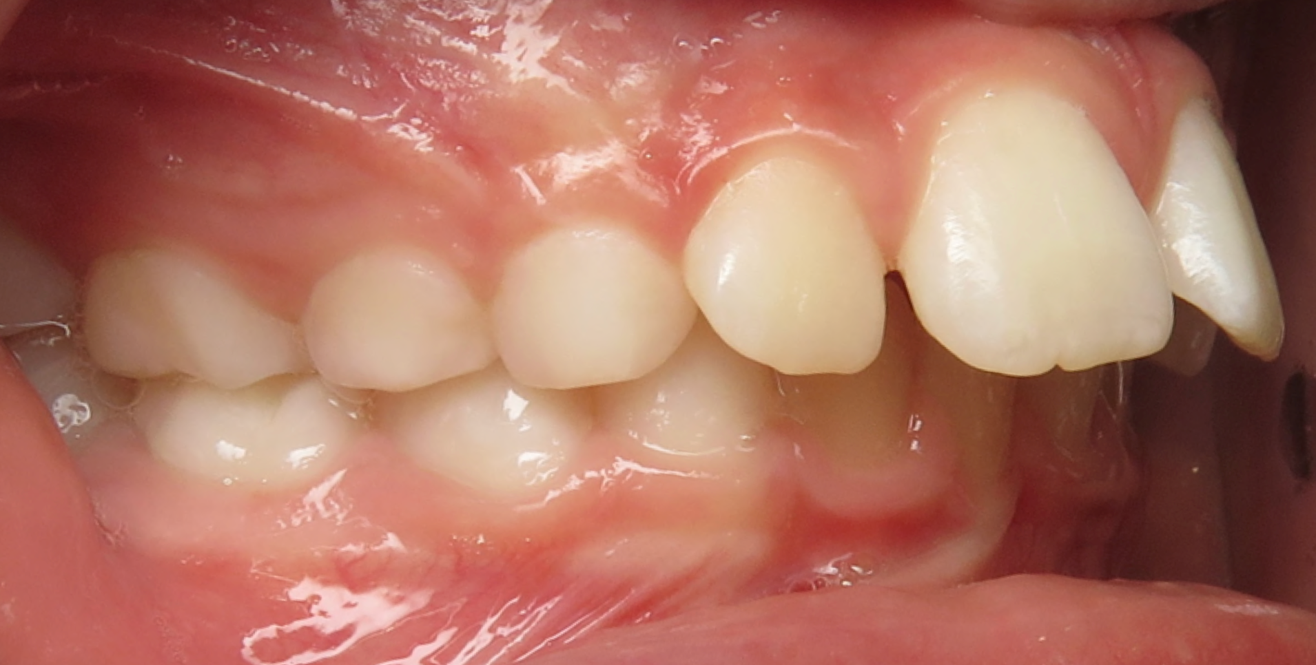 close up of a class 2 overbite patient's teeth