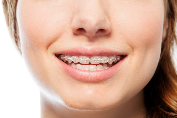 girl wearing LightForce braces to fix crooked teeth