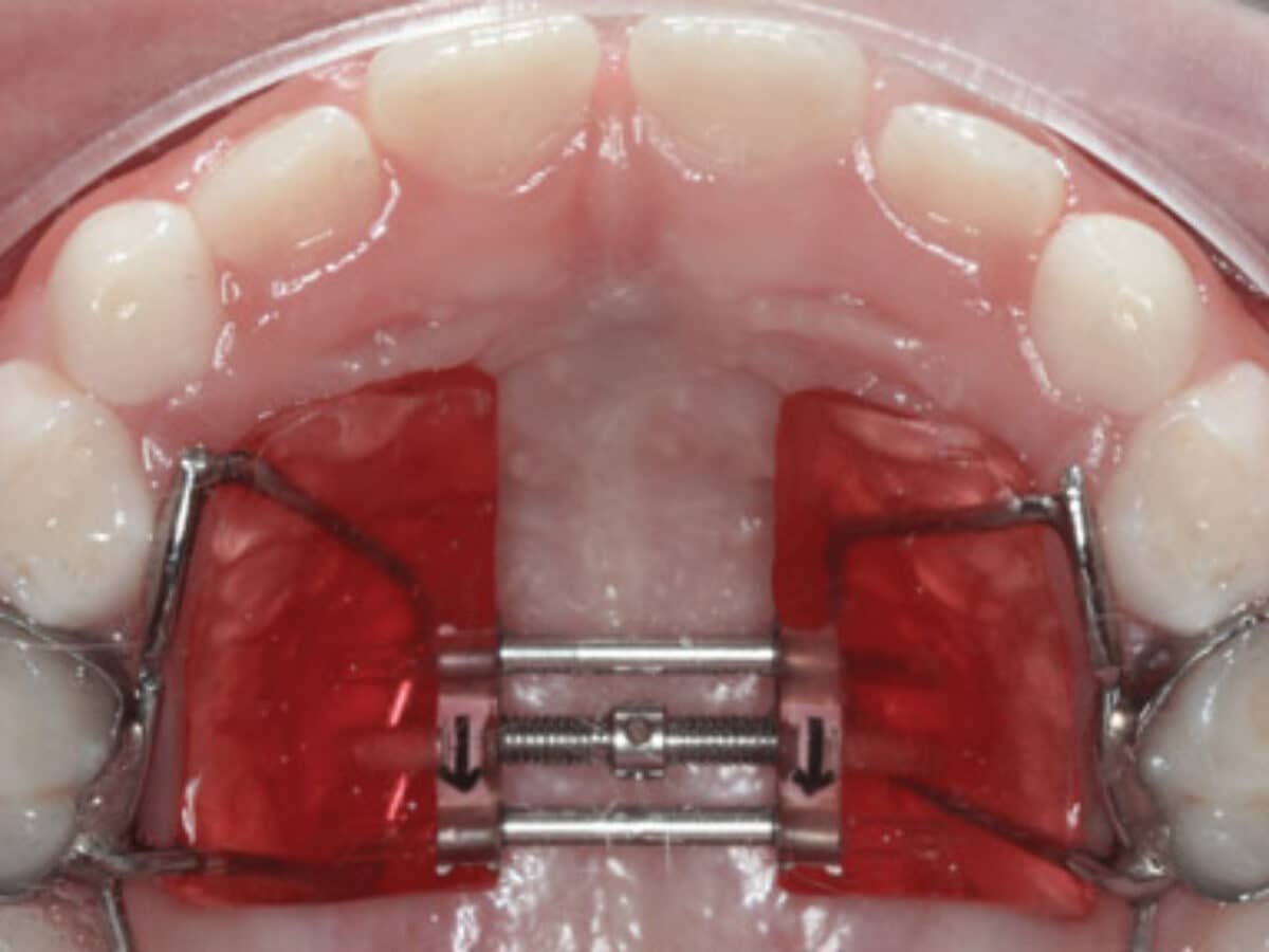a palatal expander glued into the mouth used for rapid maxillary expansion