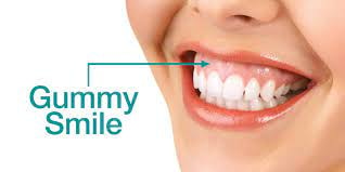 Image showing a woman with a gummy smile