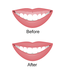 Image showing the before and after of a gummy smile