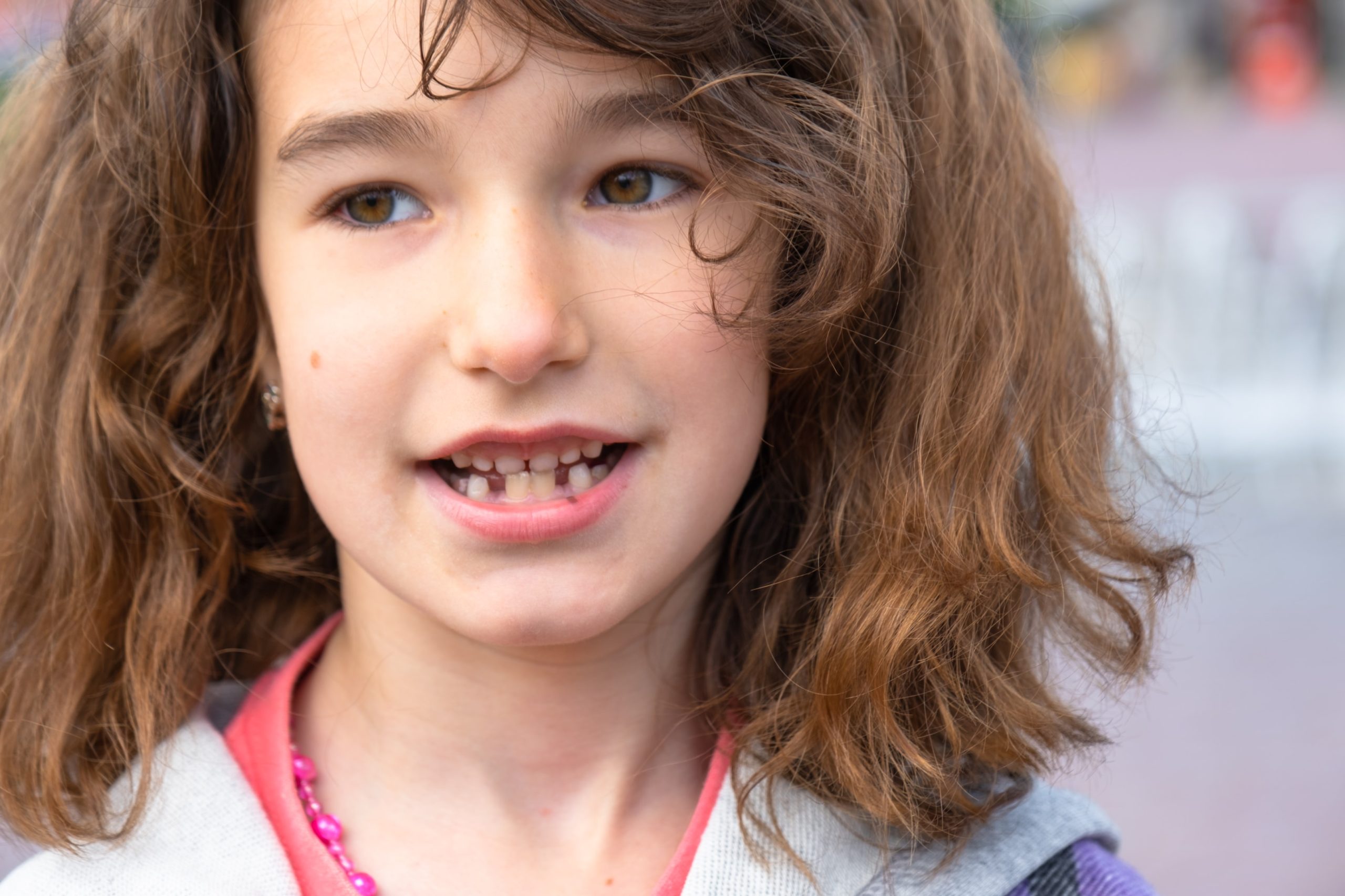 Kid with severe underbite 