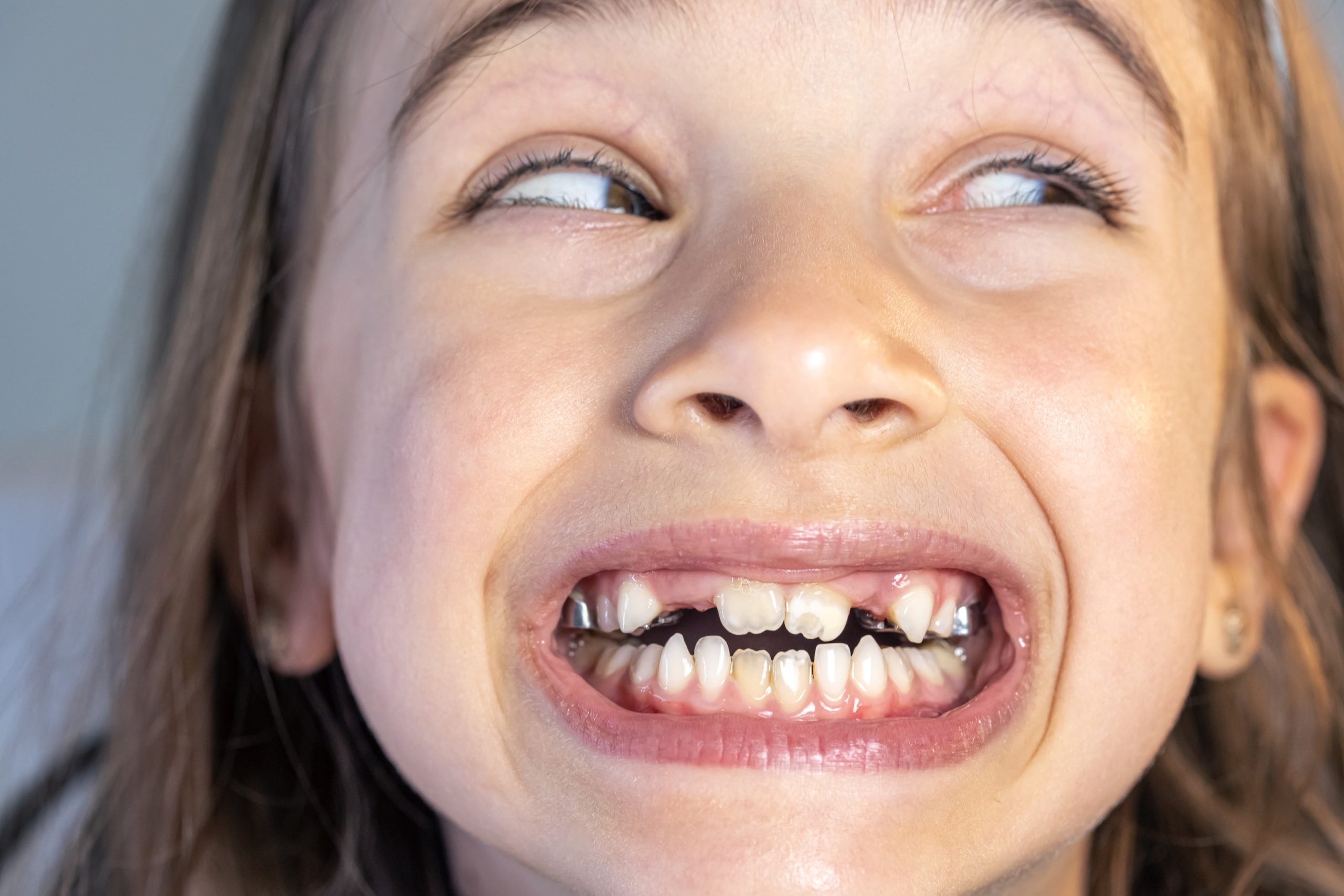 Kid smiling with slightly crooked teeth.