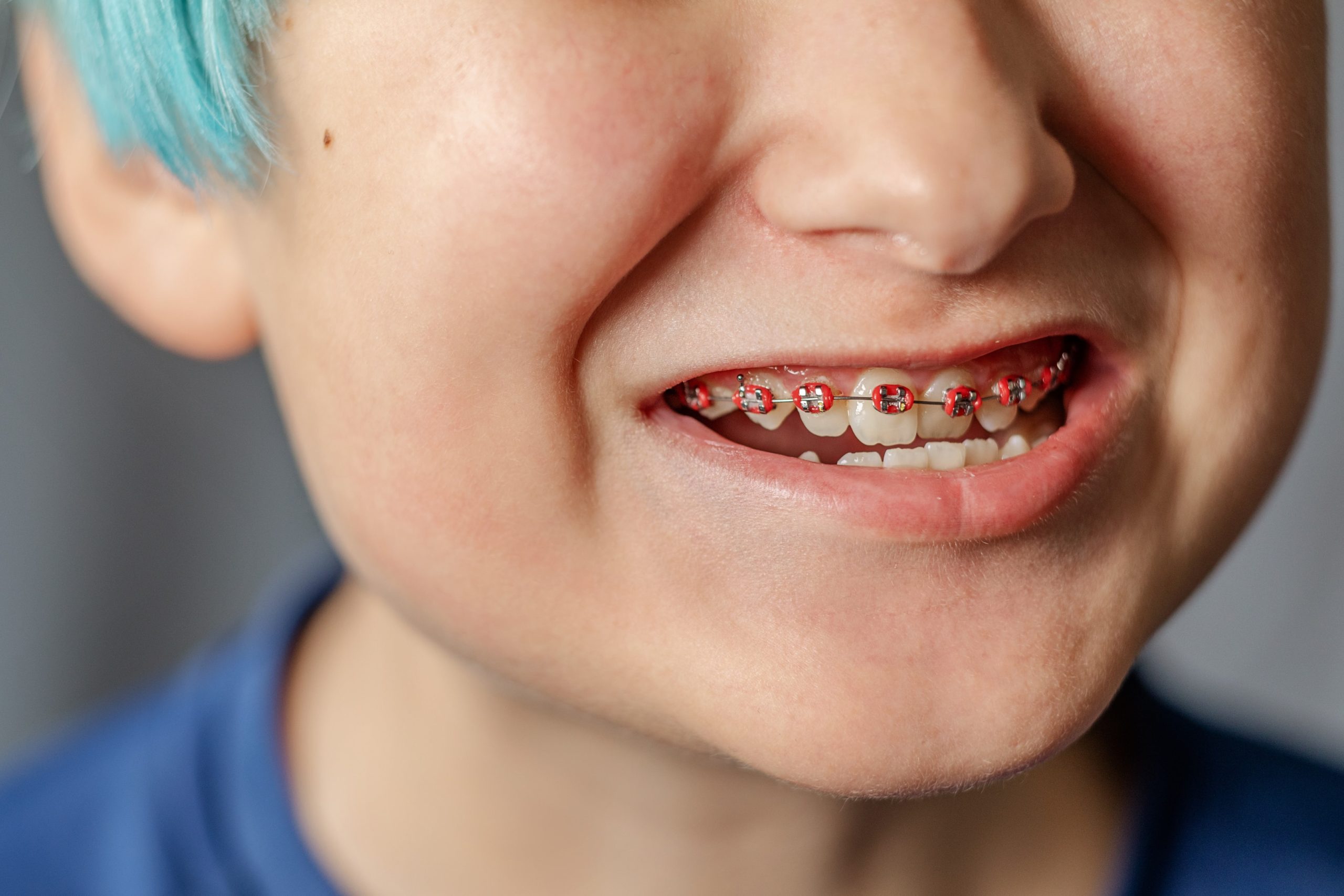 Kid wearing braces with bottom teeth forward (underbite)