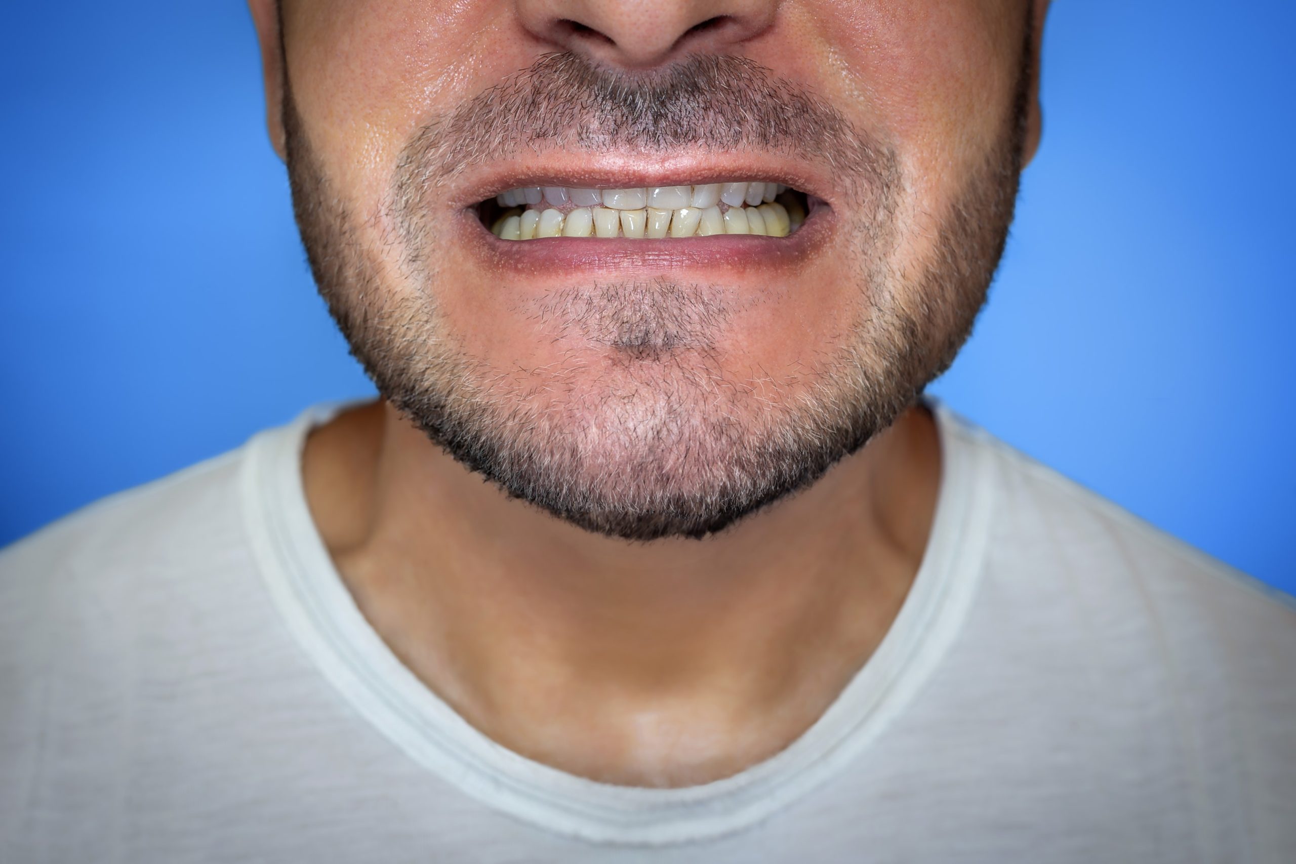 Man with severe underbite