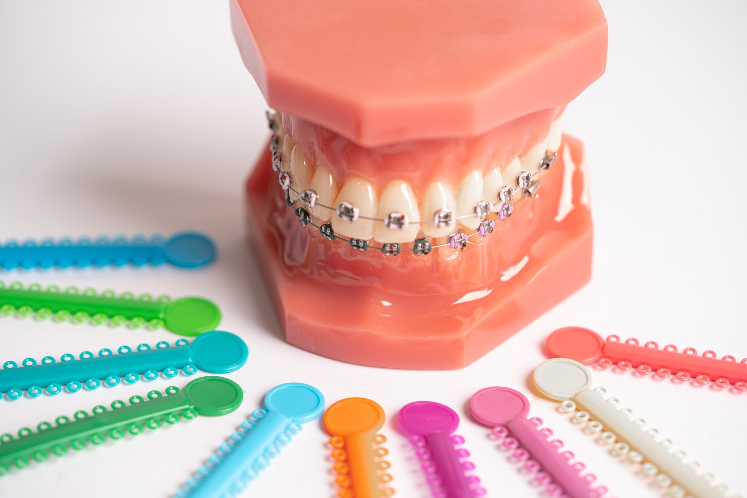 Dental model wearing traditional metal braces