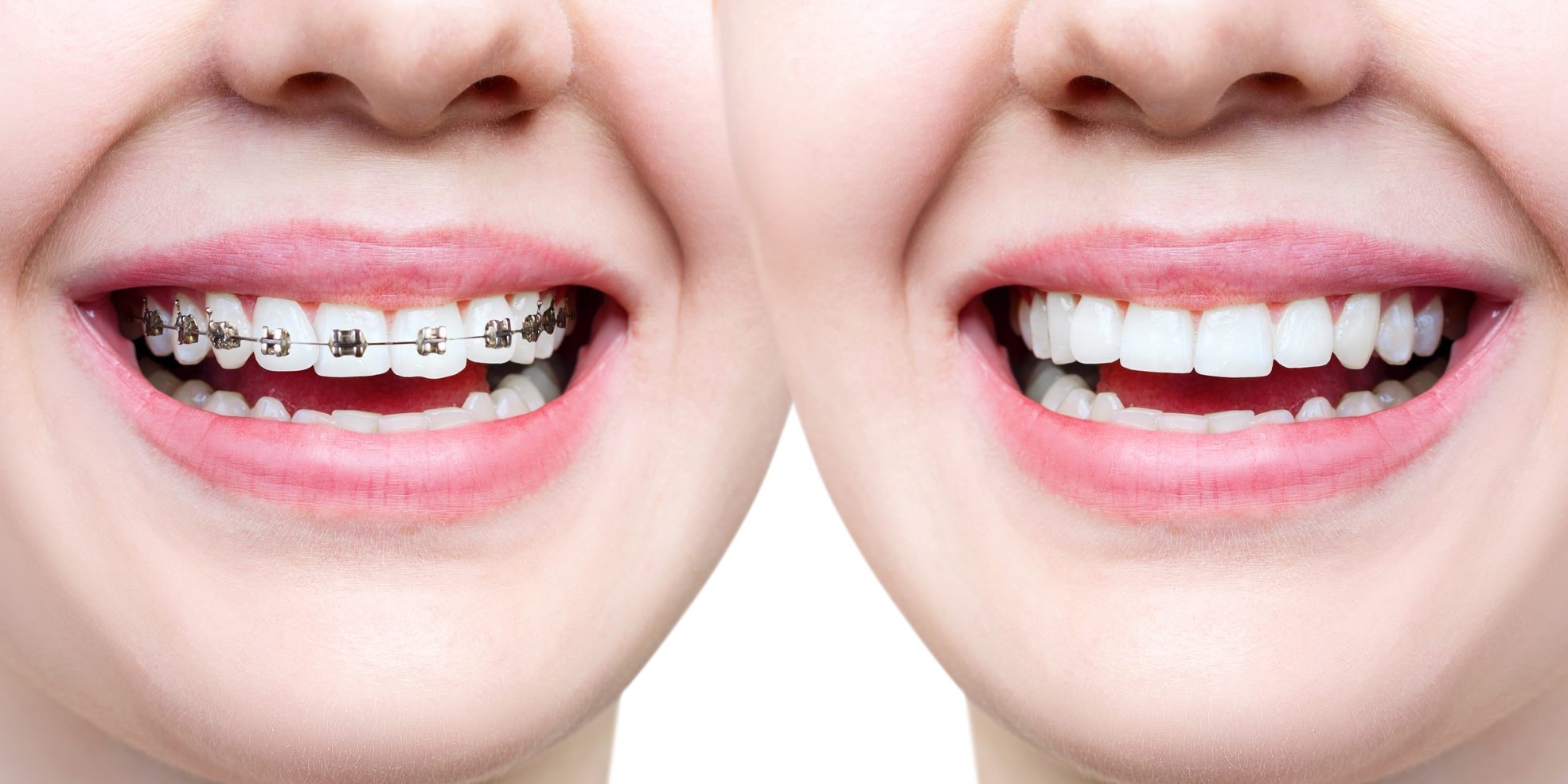 Image representing the difference between metal braces and clear aligners