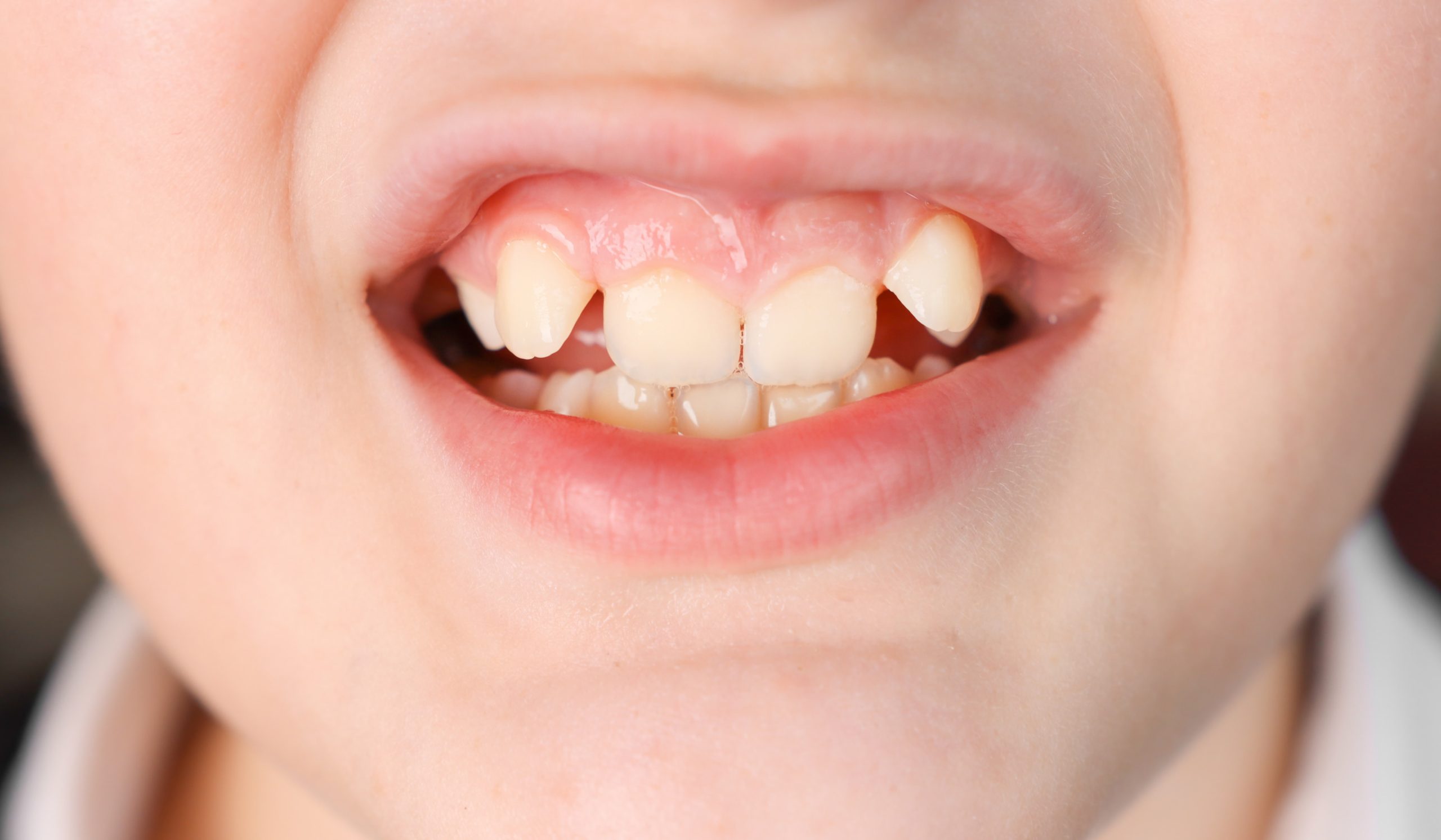 these crowded teeth would have early treatment benefit