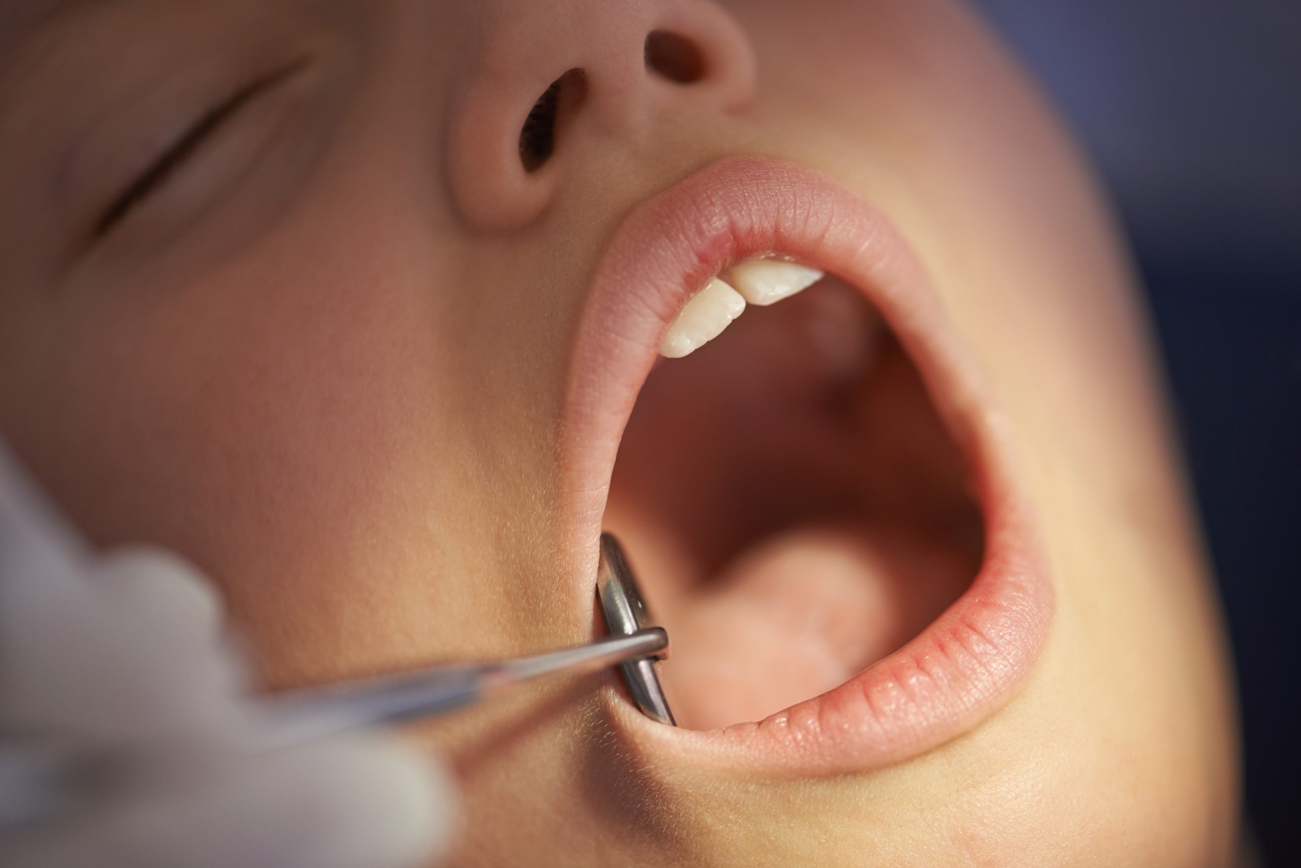 Kid getting ready to have lingual braces put on