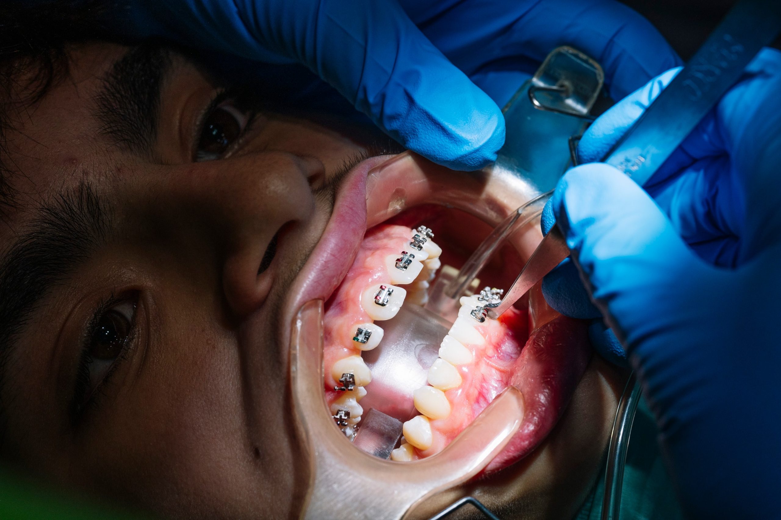 Braces used for jaw alignment