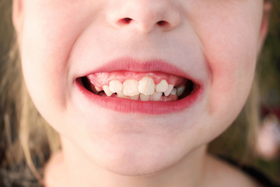 tween girl shows off very crooked teeth in need of specialist experience 