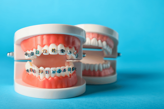 dental models showing metal braces and clear aligners 