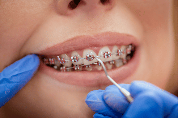 close up of braces being adjusted