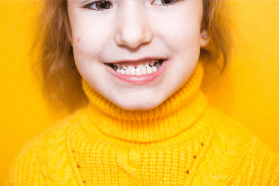 young girl with an open mouth exposing her severe underbite