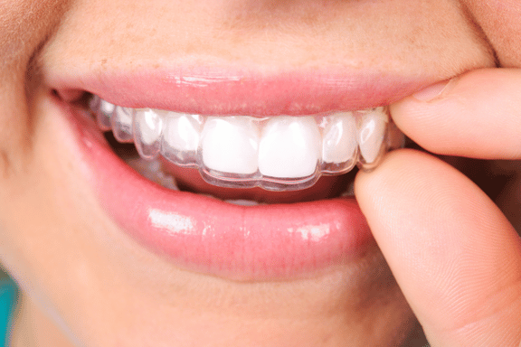 close up of a clear aligner being inserted snuggly over teeth