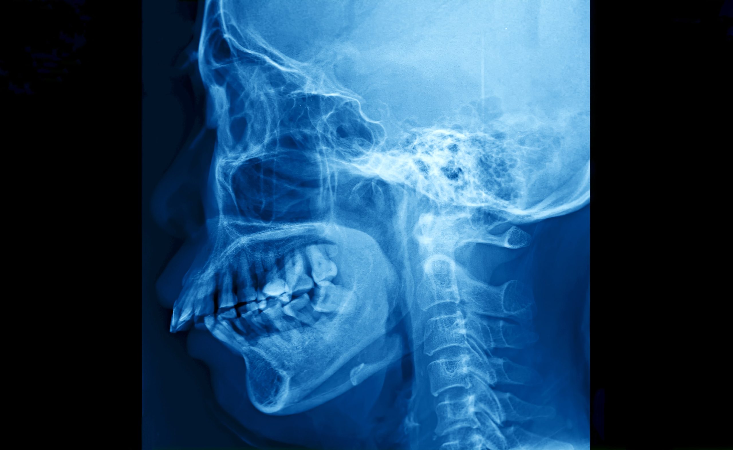 Misaligned jaw in x-ray format