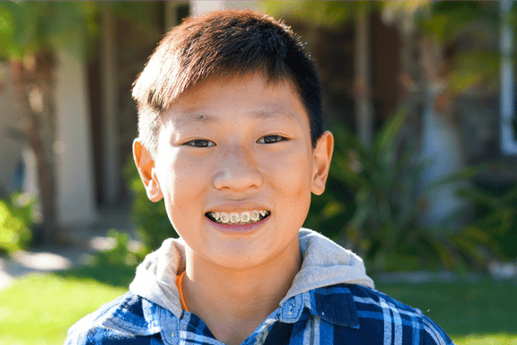 tween boy smiling showing his braces to correct teeth overlap