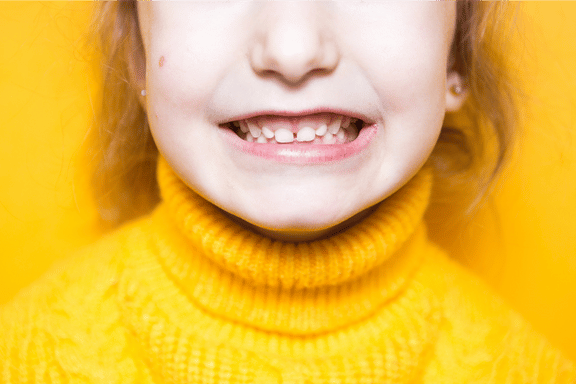 young girl showing her overbite teeth when she opens her mouth