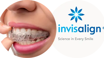 Invisalign treatment cost in Calgary, AB