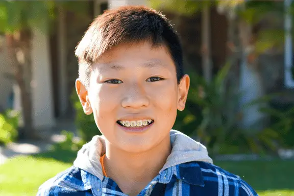 tween boy smiling showing his braces to correct teeth overlap