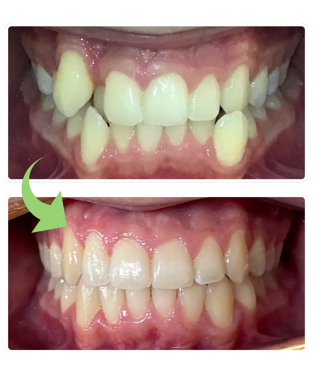 Impact orthodontics patient A.R. before and after photos
