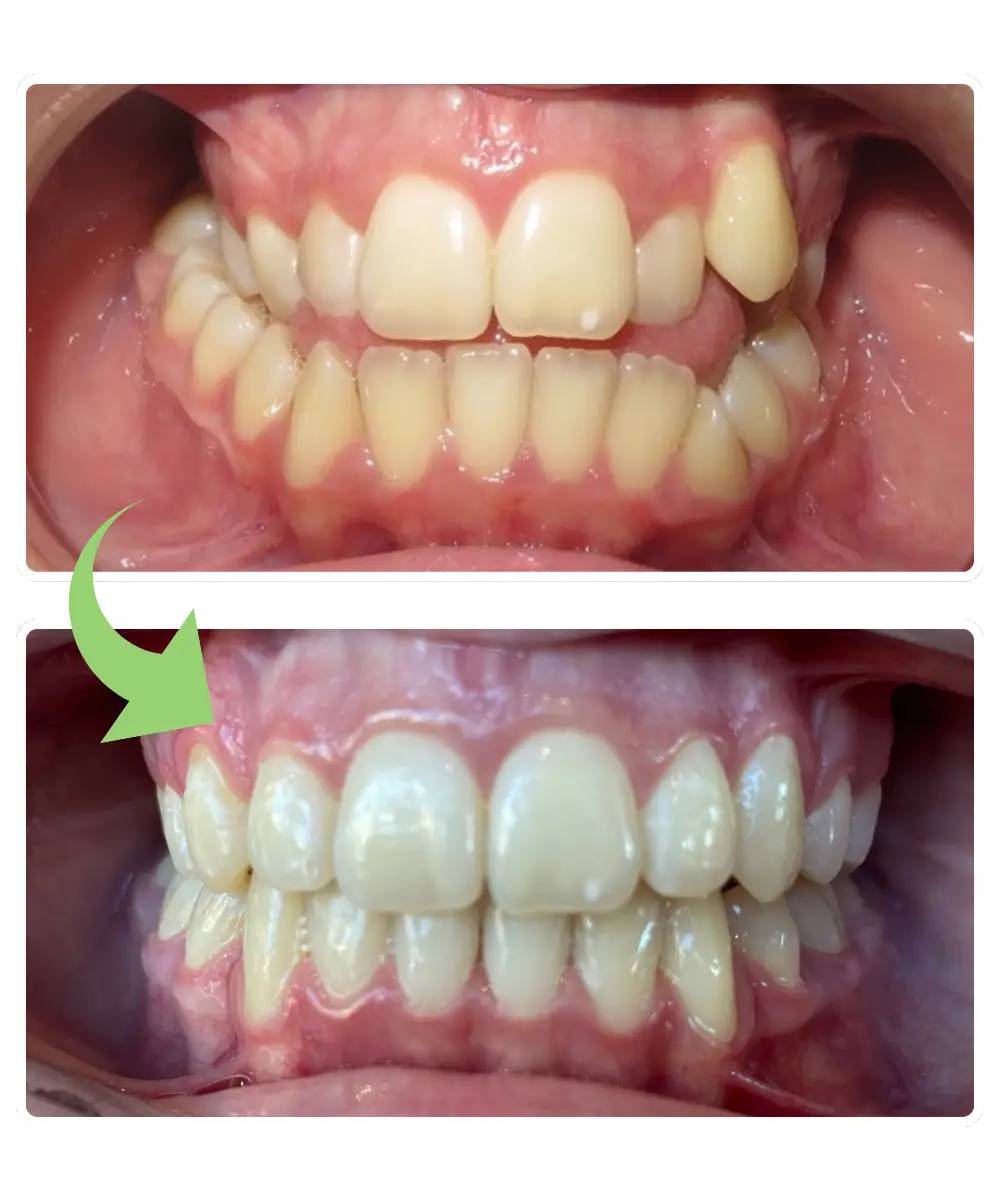 Impact orthodontics patient V.R. before and after photos